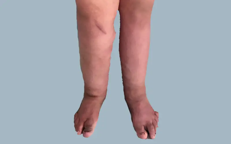 Diagnóstico y tratamiento de linfedema ofrecido por Centro de enfermedades circulatorias y pie diabético